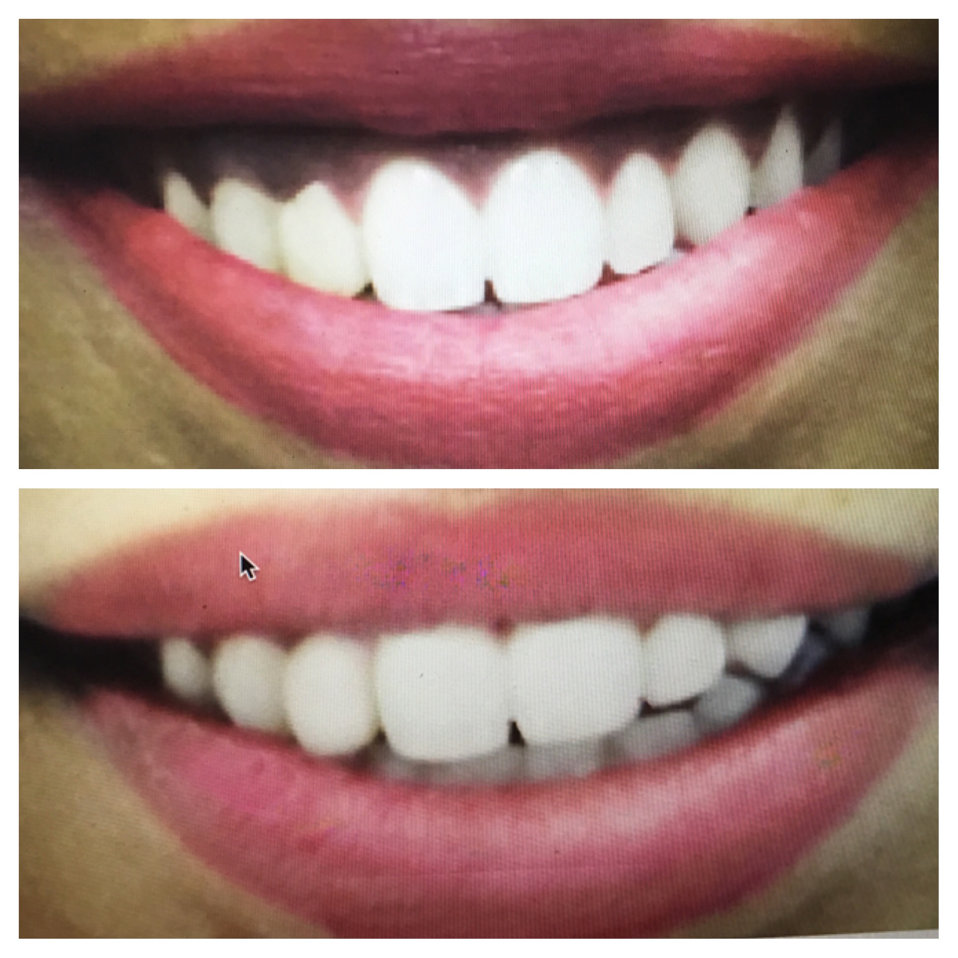 lip repositioning gummy smile rid dental