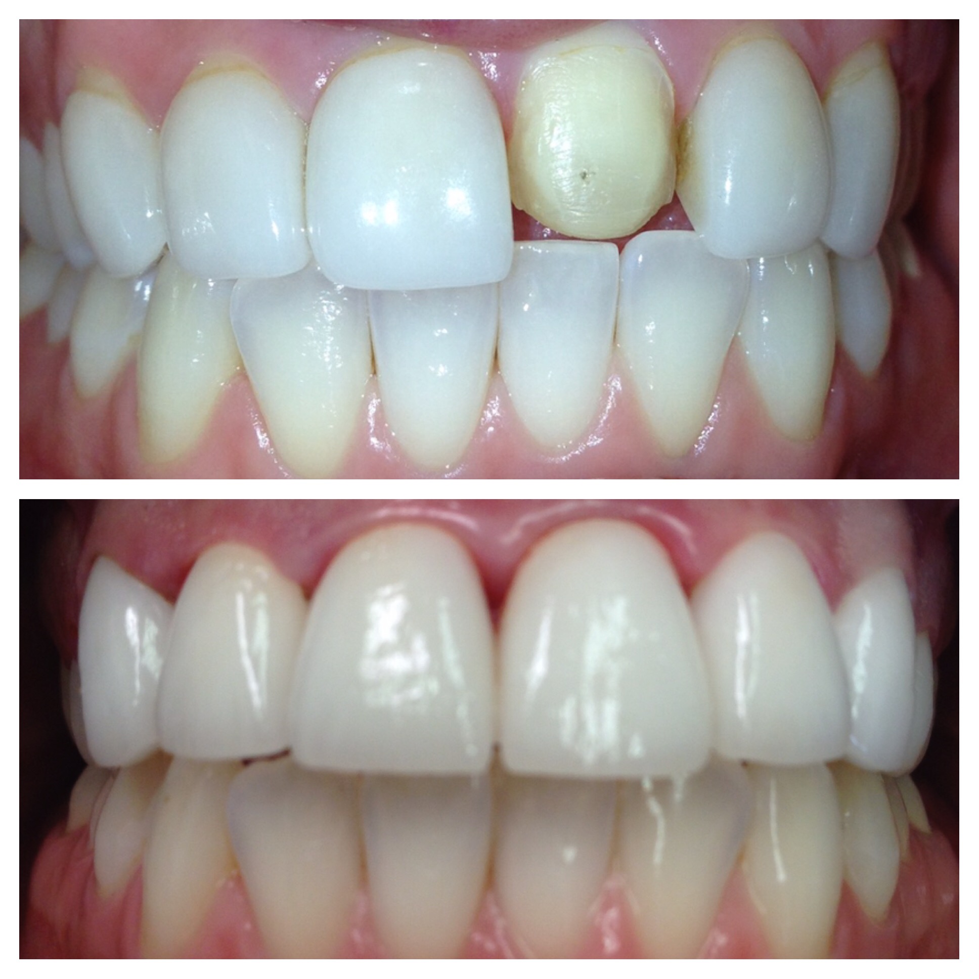 Gum Disease Treatment at Home Family Dentist The Colony Texas