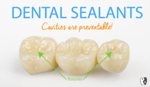 Sealants