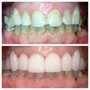 Smile Makeover