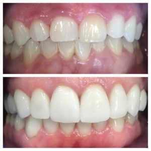 Lip Repositioning to a correct gummy smile