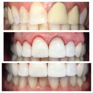 Lip Repositioning to a correct gummy smile