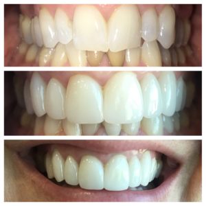 Lip Repositioning to a correct gummy smile