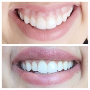 Lip Repositioning to a correct gummy smile
