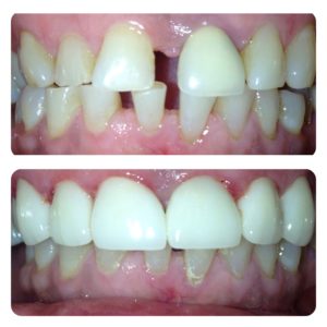 Lip Repositioning to a correct gummy smile