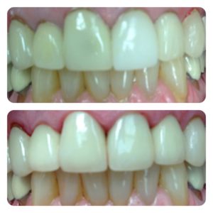Lip Repositioning to a correct gummy smile