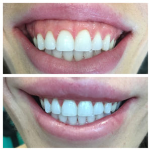 Lip Repositioning in Lewisville