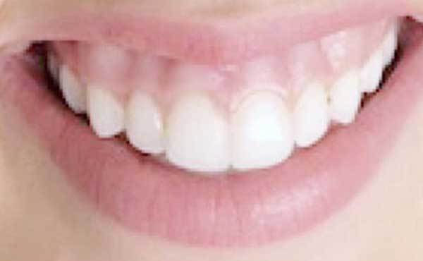 before and after cometic dentistry