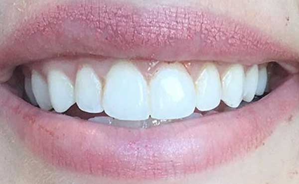 cometic dentistry in Lewisville