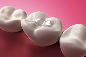 Tooth Colored Fillings Lewisville