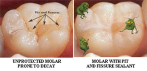 Sealants