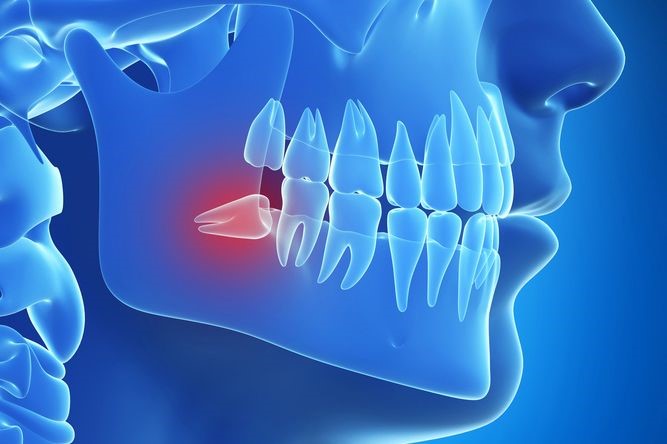 Impacted Wisdom Teeth