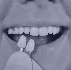 porcelain veneers lewisville