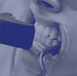 teeth whitening the colony