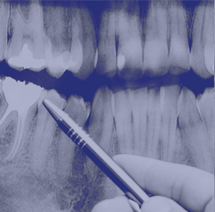 root canal lewisville