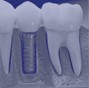 dental implants lewisville