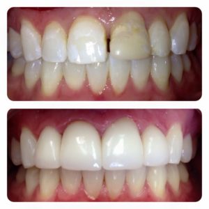 Cosmetic dentistry