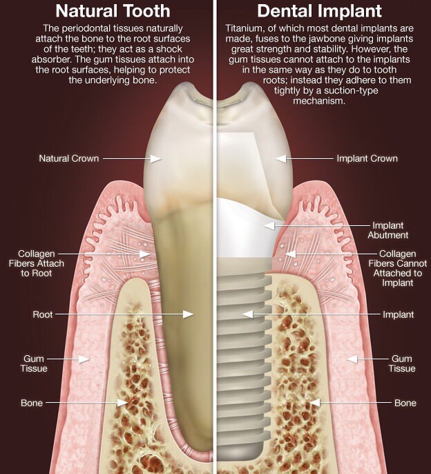 dental-implants-castle-hills