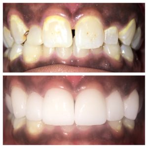 Teeth Bonding & Dental Bonding in the colony