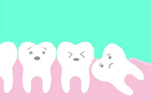 Wisdom tooth extraction