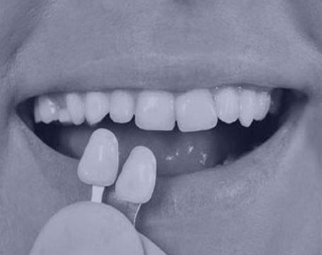 Porcelain Veneers lewisville