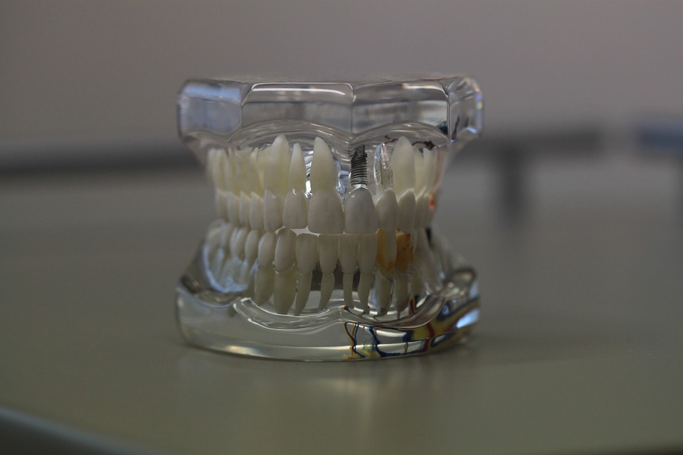 How Many Teeth Should be Lost before Applying Dentures?
