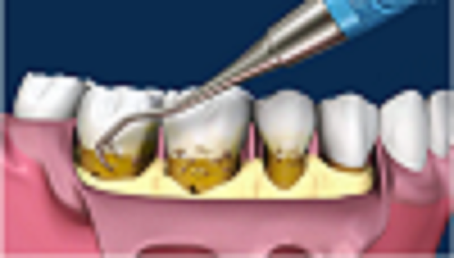 What is Laser Dentistry Deep Cleaning?