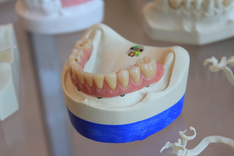 Top Oral Care Tips for Bridges and Crowns