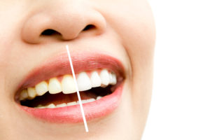 How Long Does It Take to Whiten Teeth Naturally?