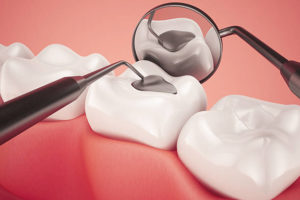 What is the Best Type of Filling for Teeth?