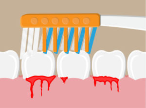 Causes of Bleeding Gums and How You Can Treat Them