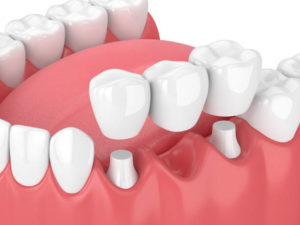 What are the Pros and Cons of a Dental Bridge?