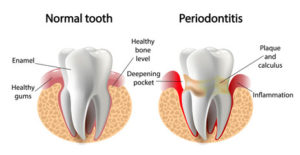 What is Considered Advanced Periodontal Disease?