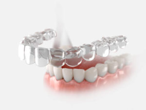 How Does Invisalign Fix Crooked Teeth?