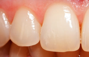 tooth enamel