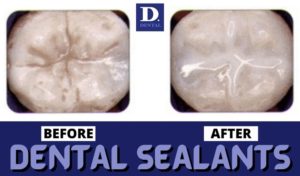 Dental Sealants in The Colony