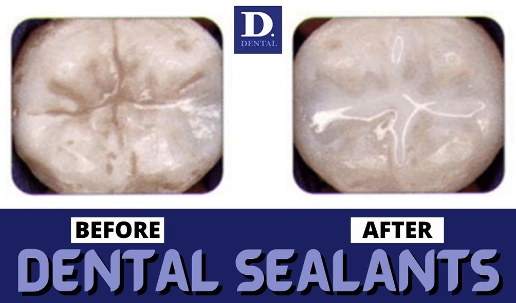 Are Dental Sealants Safe?