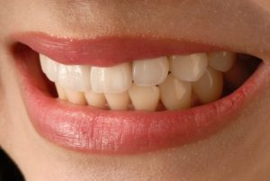 Porcelain Veneers in The Colony