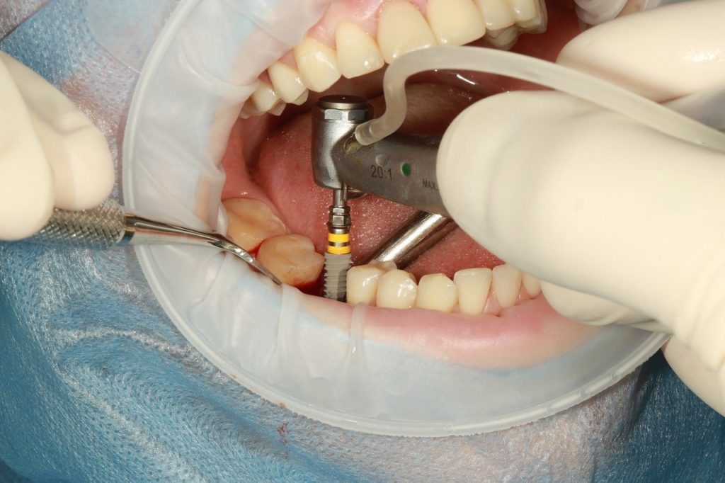 dental implants castle hills