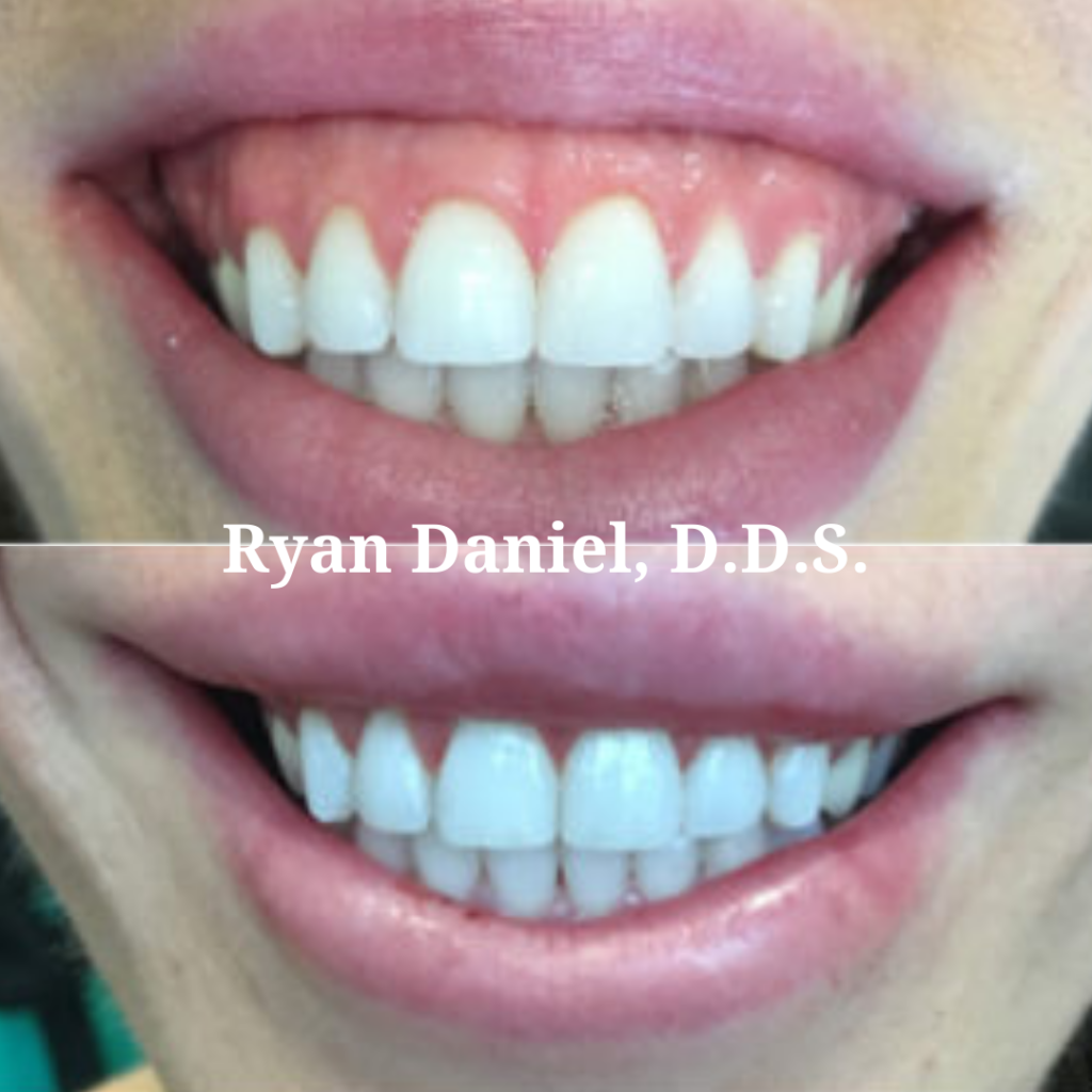 Lip Repositioning Treatment