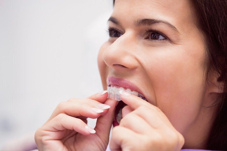 Does Invisalign Cause White Spots on Your Teeth? - D. Dental