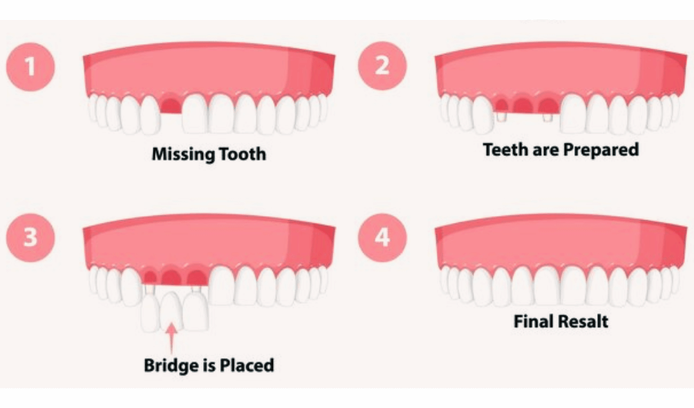 Enhance Your Smile with Dental Crowns and Bridges