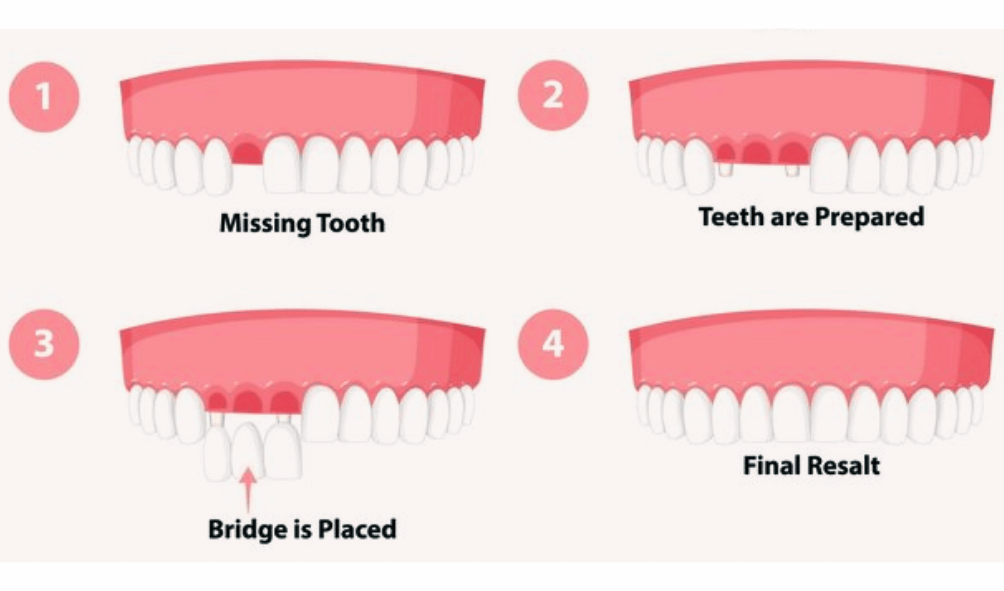 Enhance Your Smile with Dental Crowns and Bridges - D. Dental