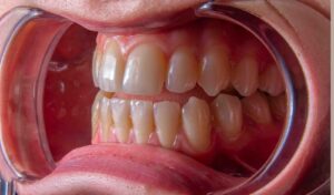 Periodontal disease