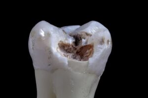 Broken root canal