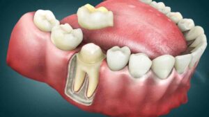Pain After Root Canal