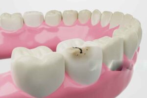 wisdom tooth extraction