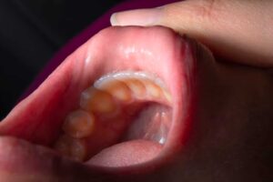Common Causes of Tooth Infection That Require Root Canal Therapy