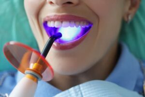 Top Benefits of Dental Sealants for Cavity Prevention